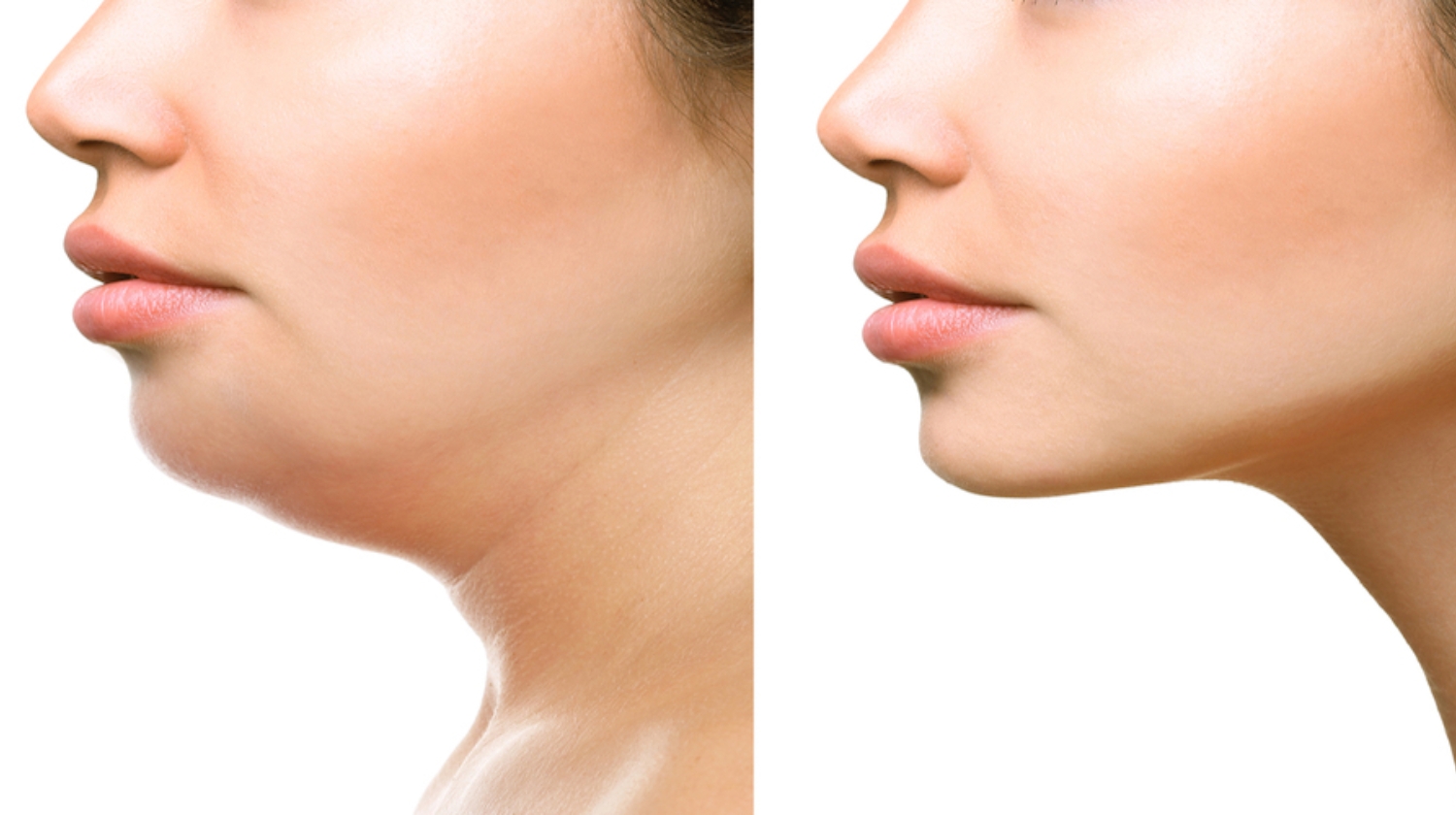 How to Get Rid of Double Chin