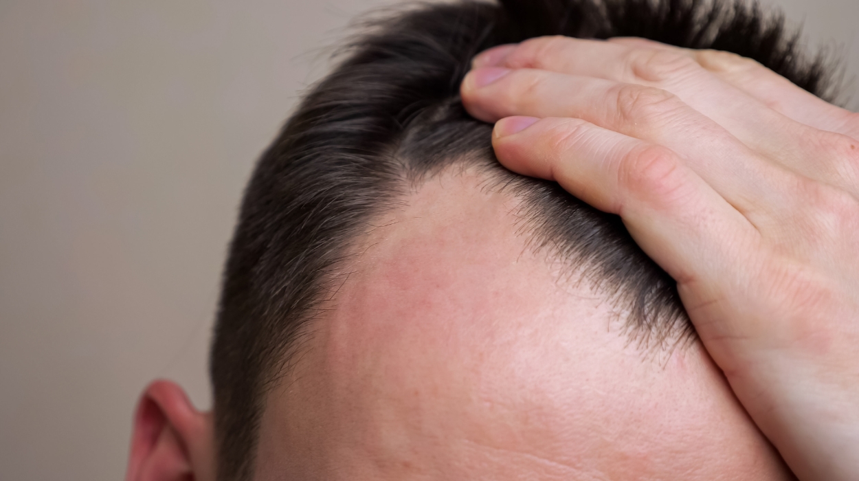 How To Regrow Hair On Bald Spot Fast