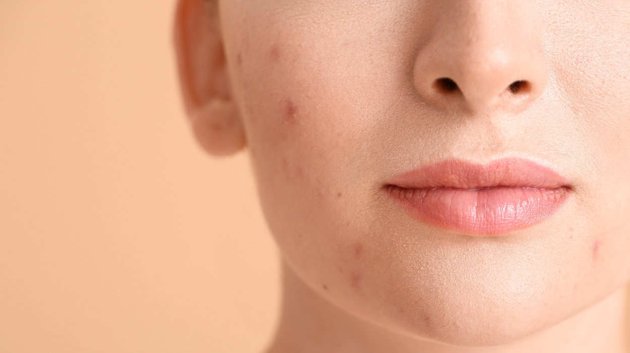 How To Use Apple Cider Vinegar For Acne